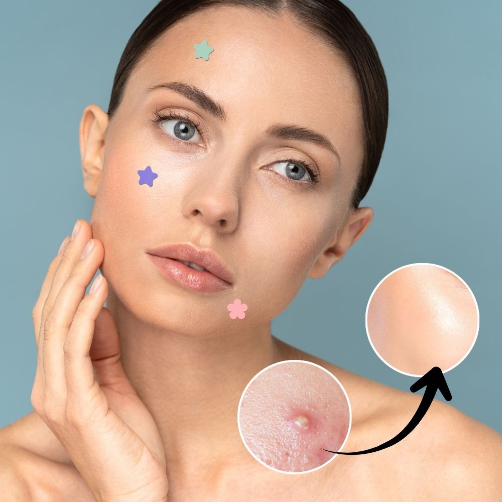 Hydrocolloid Pimple Acne Patch Sticker - product detail 3