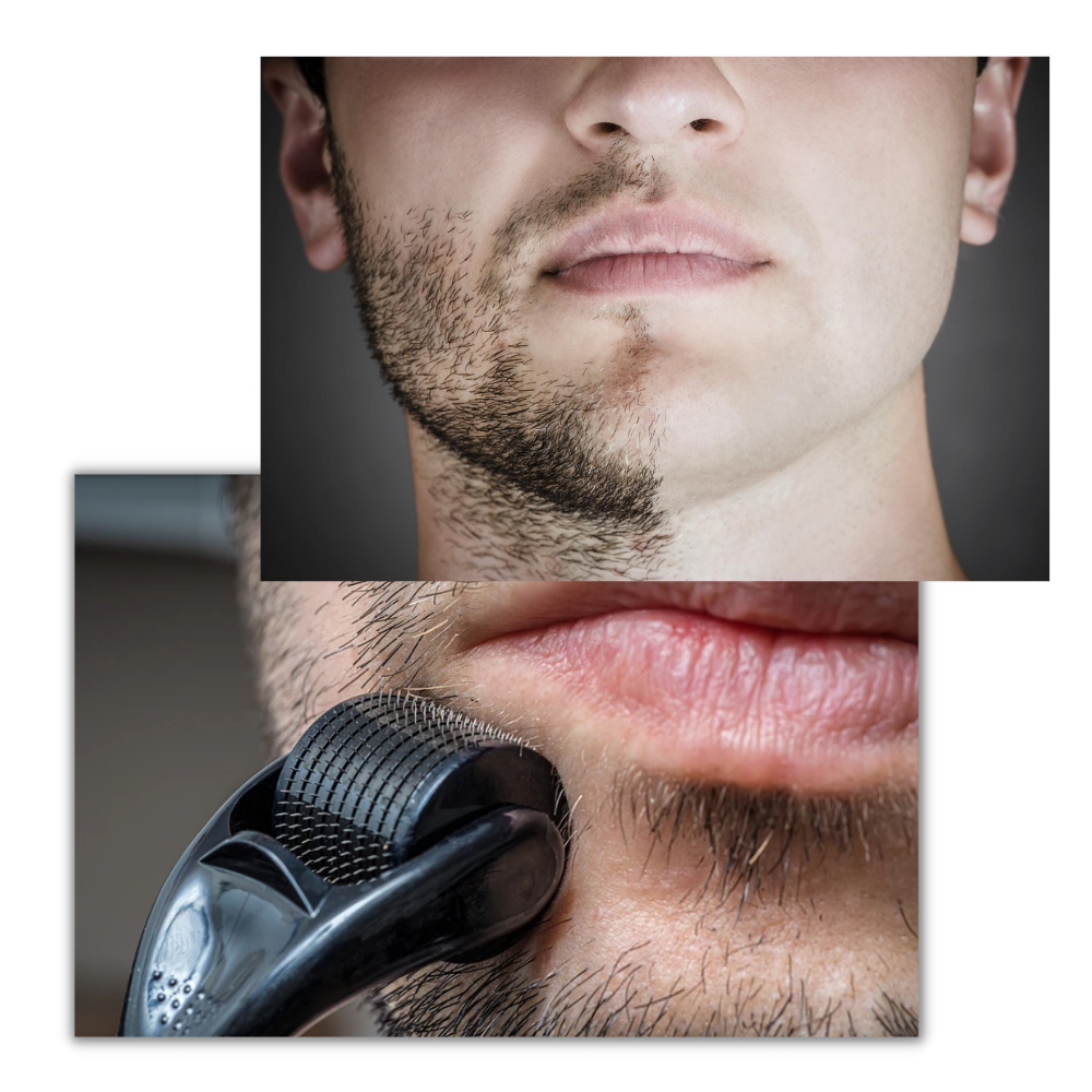 Dermal Roller For Hair And Beard Growth - product detail 3