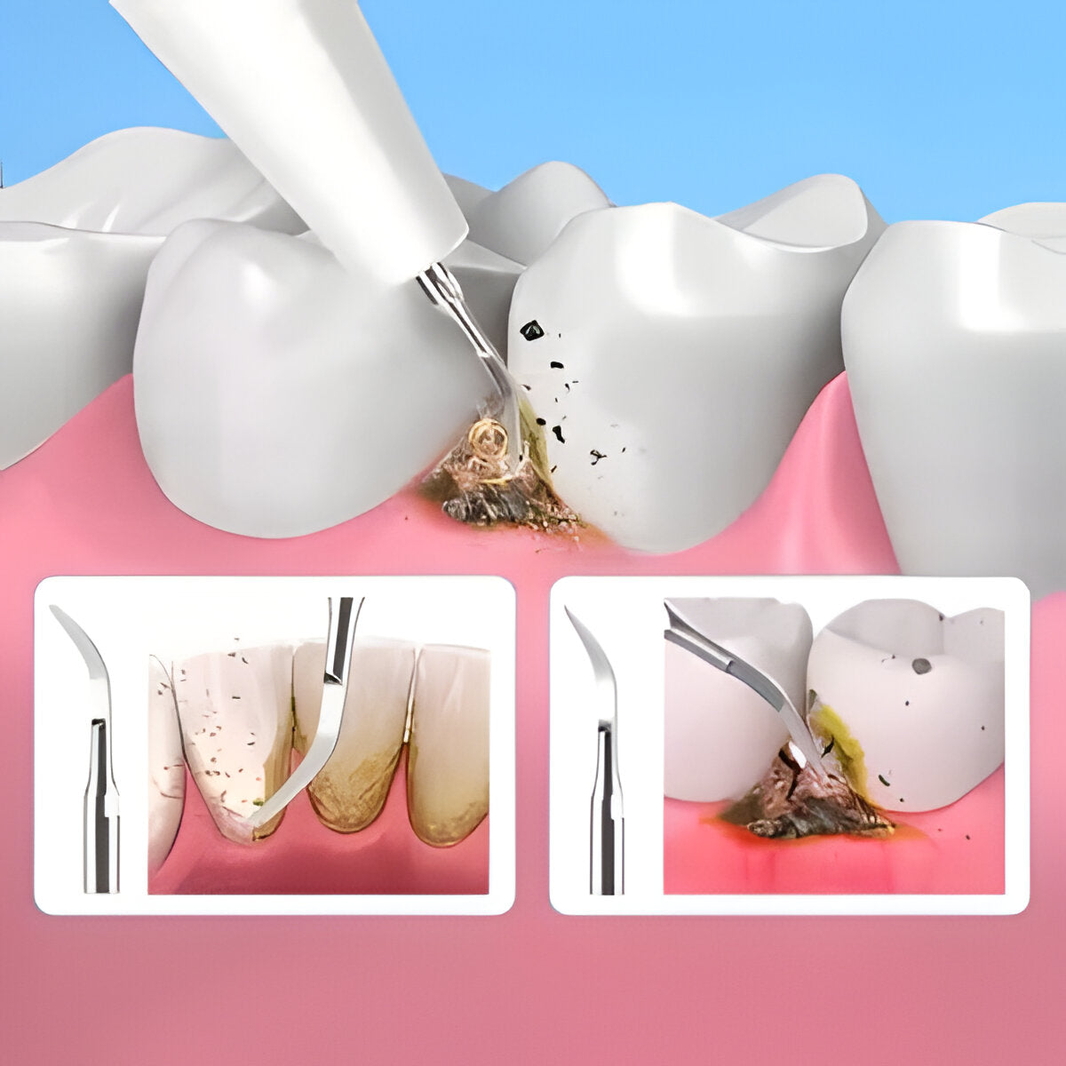 Ultrasonic scaler - product image 5