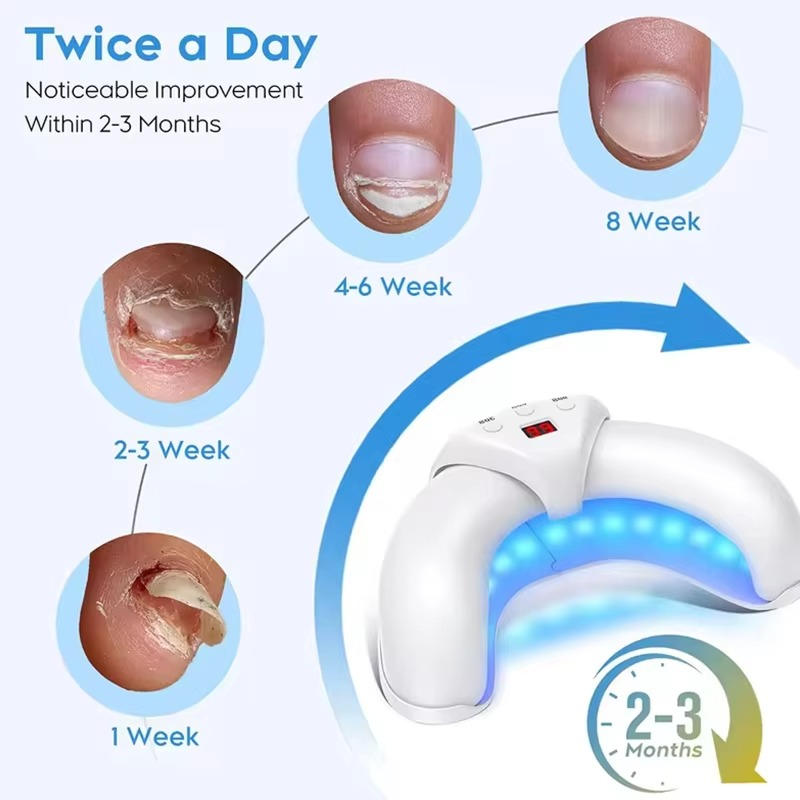 Nail Fungus Laser - product detail 3