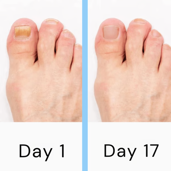 Nail Laser Fungus Device - product detail 5