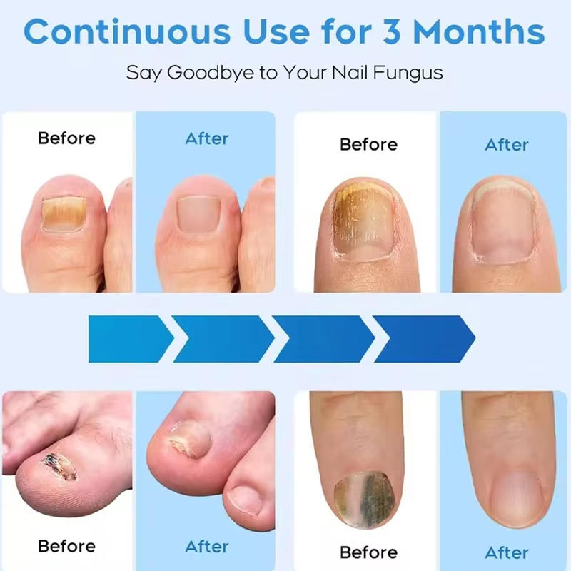Nail Fungus Laser - product detail 5