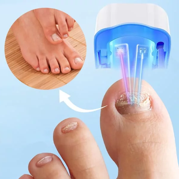 Nail Fungus Cleaning Laser Device - product image 4