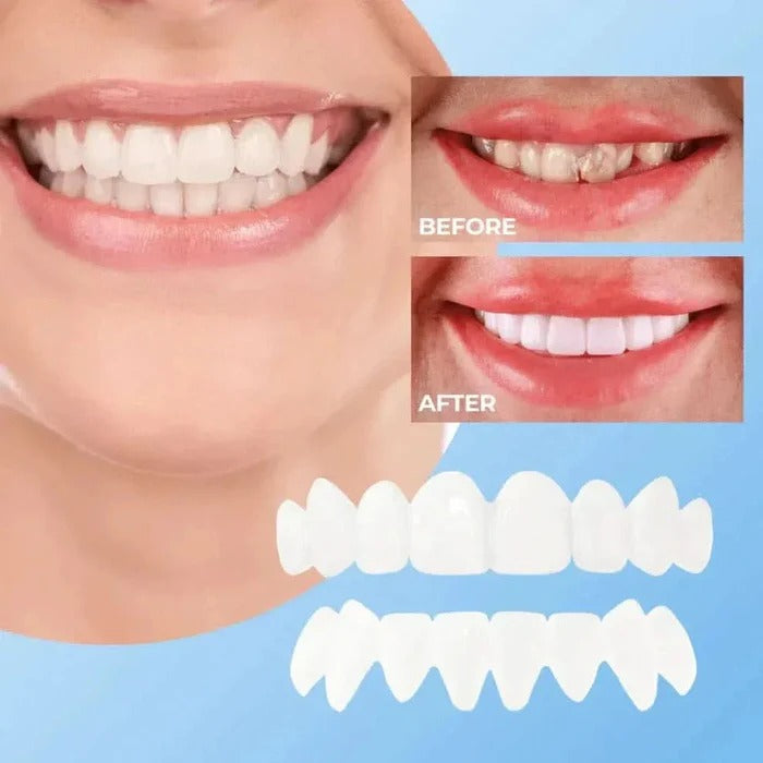 Veneers for Teeth with Natural White Finish - product detail 4